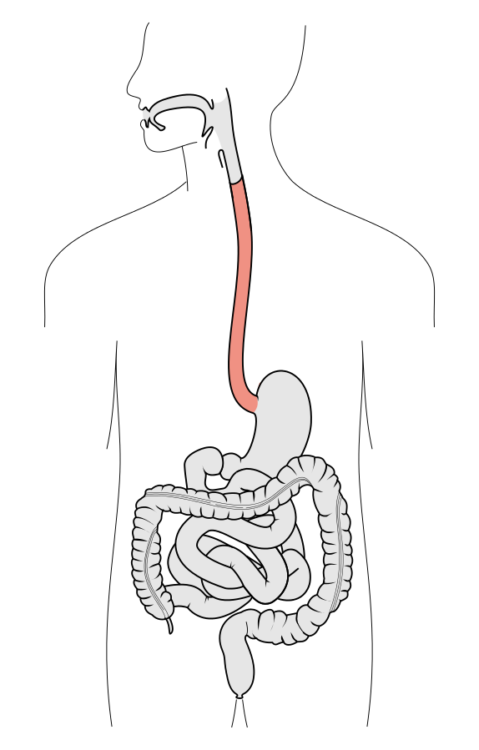 Esophageal Stricture Symptoms And Treatment Medical Library