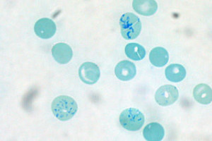 Anemia Overview Microcytic Macrocytic Normocytic Anemia