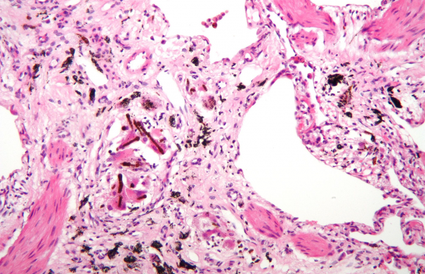 Asbestose, Asbeststaublungenerkrankung MedizinLexikon