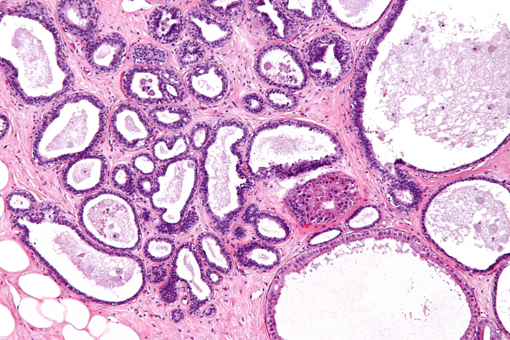 Mastopathie | Medizin-Lexikon | Online Lernen mit Lecturio