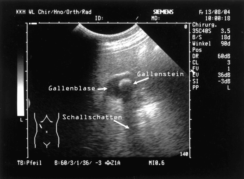 Cholelithiasis, Gallensteinleiden | Medizin-Lexikon | Lecturio
