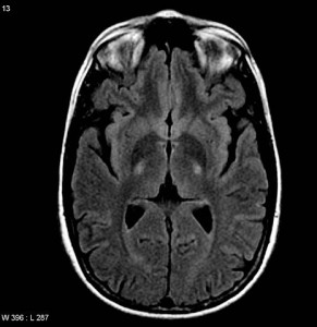 ALS-Kopf-MRT