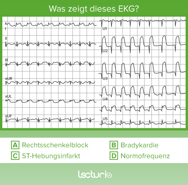 EKG_Quiz_2