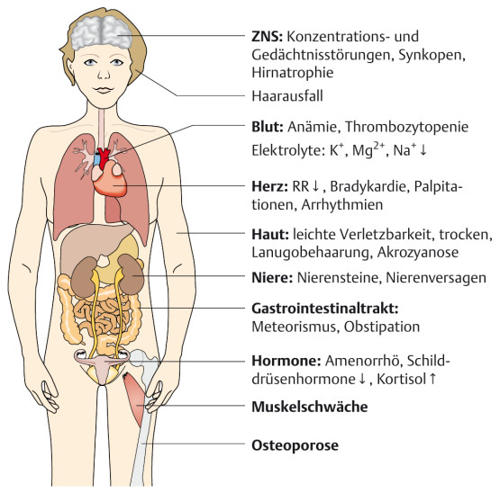 Anorexie Bulimie Binge Eating Essstorungen Im Uberblick