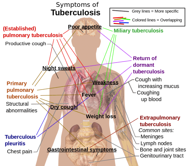 Tuberkulose Symptome