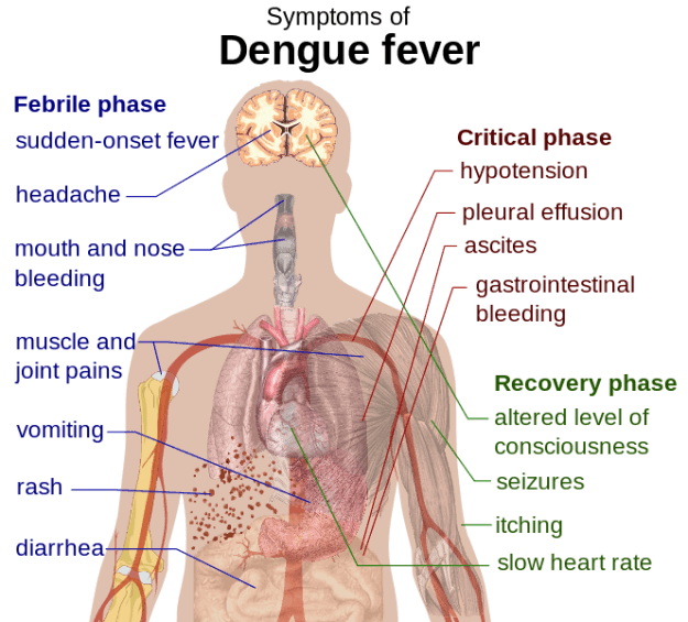 Dengue_fever_symptoms.svg