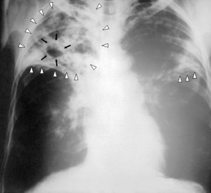 Eine Röntgenaufnahme im anterior-posterioren Strahlengang eines Patienten, bei dem eine beidseitige Lungentuberkulose festgestellt wurde