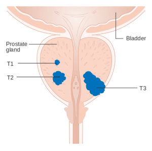Diagram_showing_T1-3_stages_of_prostate_cancer_CRUK_278.svg