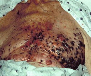 Malignes-melanom-auf-brust