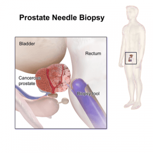 Prostate_Needle_Biopsy