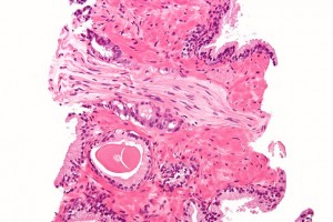 Prostatic_adenocarcinoma_with_perineural_invasion