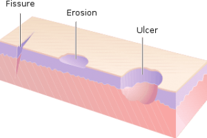 Ulcers fissures,and erosions