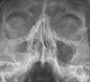 Sinusitis maxillaris rechts (im Röntgenbild links) .„Sinusitis maxillaris Roe 001“ von Hellerhoff - Eigenes Werk. Lizenziert unter CC BY-SA 3.0 über Wikimedia Commons.