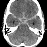 Subarachnoidalblutung im CT