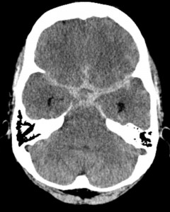 Subarachnoidale Blutung in der Computertomographie Subarachnoidale Blutung in der Computertomographie