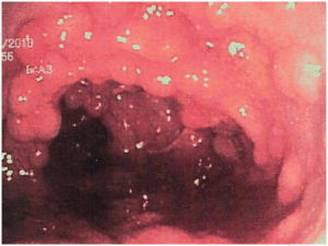 Darmschleimhaut mit adenomatösen Polypenteppich bei einem Patienten mit familiärer adenomatöser Polyposis