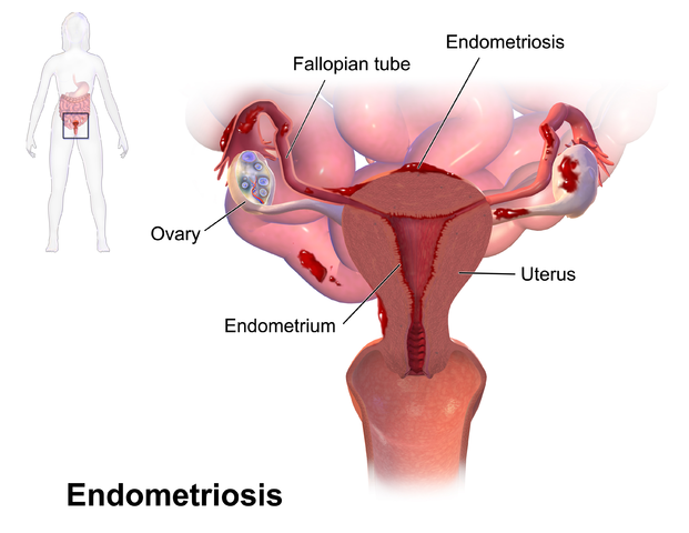 Schematische Darstellung der Endometriose