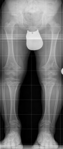Röntgenbild Stehaufnahme der Beine bei einem 10-jährigen Jungen mit Achondroplasie