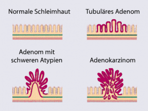 Schema der Adenom-Karzinom-Sequenz nach Vogelstein Schema der Adenom-Karzinom-Sequenz nach Vogelstein