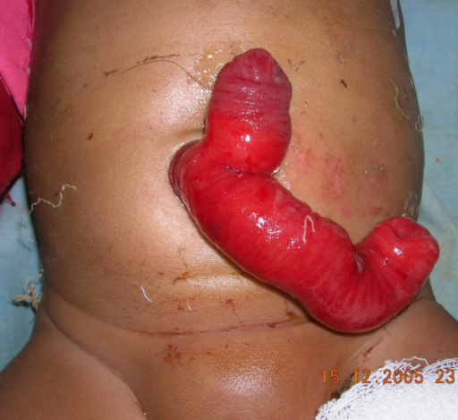 Der Darm wurde bis zur Geburt nicht vollständig zurück in den Bauchraum verlagert