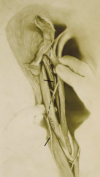 Depicts the path of the musculocutaneous nerve