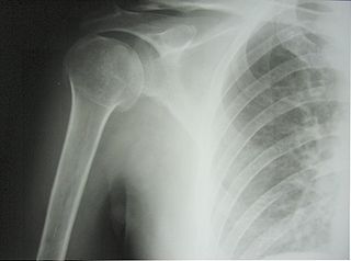 operierte Humerusfraktur, Röntgenbild