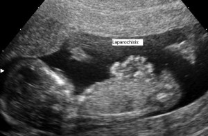 das ist das ultraschallbild einer laparoschisis