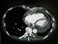 CT-Aufnahme eines Perikardergusses