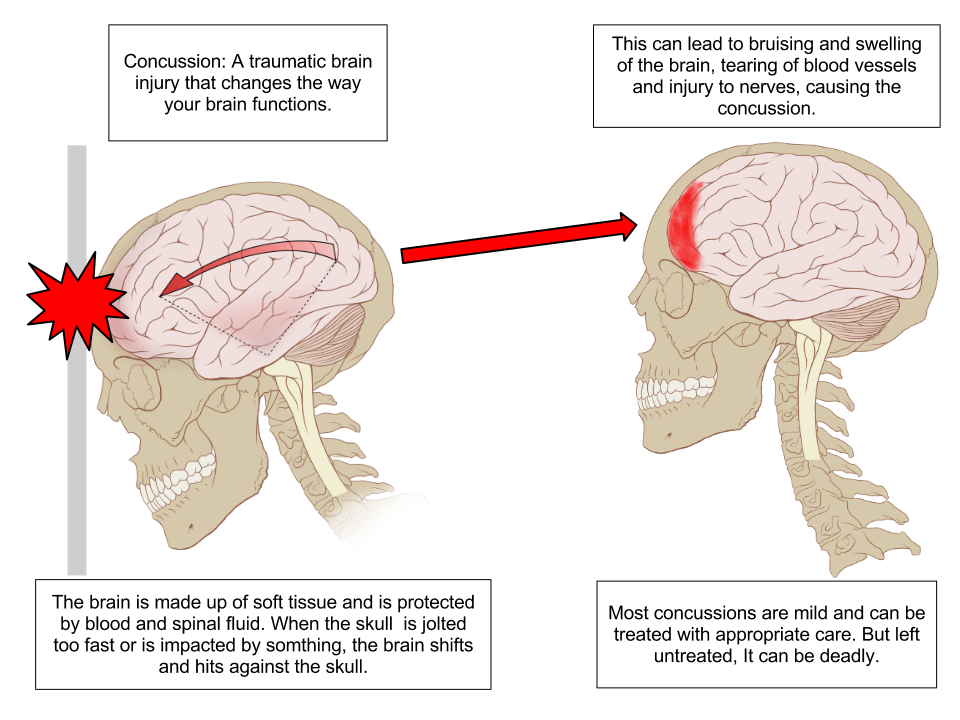 image of a Concussion because of brain injury