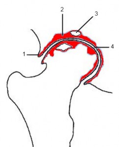 Schematische Darstellung der radiologischen Zeichen der Hüftgelenksarthrose: (1) (Rand-)Osteophyt (2) subchondrale Sklerosierung (3) Geröllzyste (4) Gelenkspaltverschmälerung