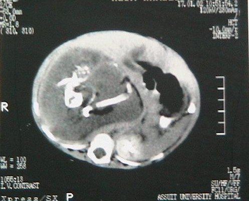 Foetus in foeto