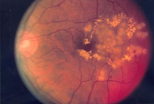 Diabetische Retinopathie nach fokaler Laserbehandlung