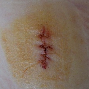 Image of stitches