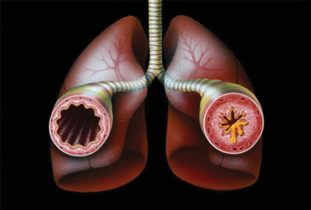 bronchial wall in asthma