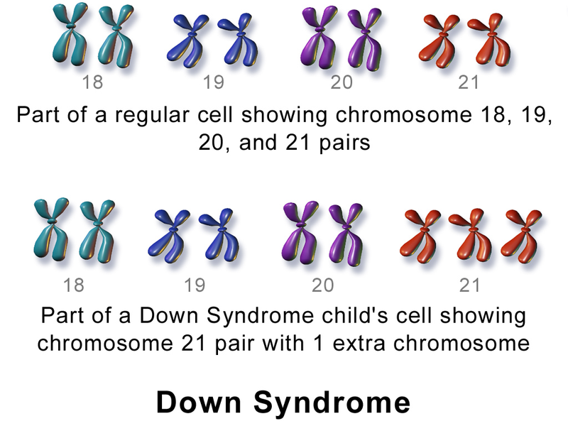 down syndrom