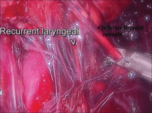 Larynx Nerv Endoskopie