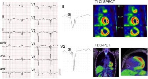 Fragmented QRS in a 52-year-old patient with cardiac sarcoidosis