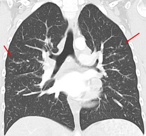 Sarkoidose in der Computertomographie koronar: Stadium II mit vielen kleinen Granulomen in der Lunge auf beiden Seiten (Pfeile)