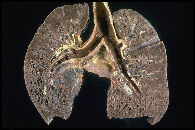 Pathologisches Präparat einer Lungensarkoidose im Endstadium