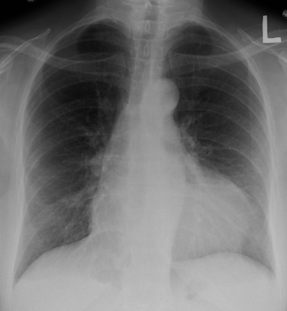 Röntgenbild mit Perikarditis
