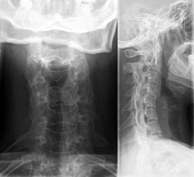 Ankylosen der Halswirbelsäule bei einer ca. 40-jährigen Frau mit abgelaufener juveniler Arthritis.