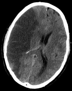 CT-scan of the brain with a RIGHT MCA infarct
