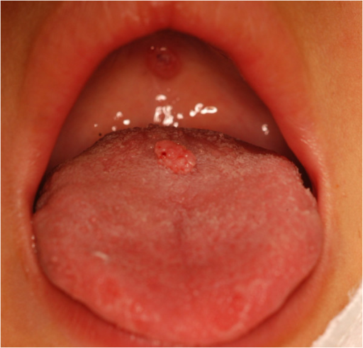 Condyloma acuminata auf der Zunge und am Gaumen eines 5 jährigen sexuell missbrauchten Jungen