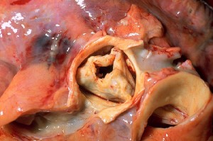 Durch rheumatisches Fieber bedingte erworbene Aortenstenose