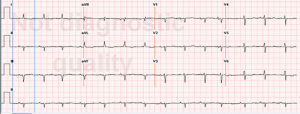 Dieses Bild zeigt ein EKG mit Niedervoltage