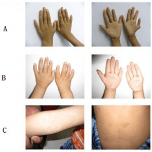 Fanconi anemia
