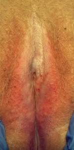 Lichen sclerosus
