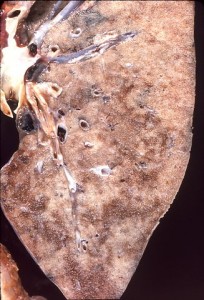 Pneumocystis jeroveci Pneumonie Pneumocystis jeroveci Pneumonie