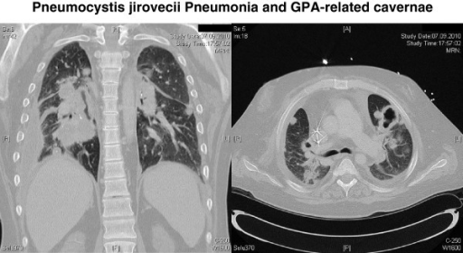Pneumocystis jirovecii pneumonia