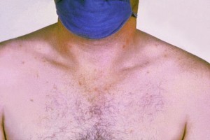 Roseolen-auf-der-Brust-eines-an-Typhus-erkrankten-Patienten